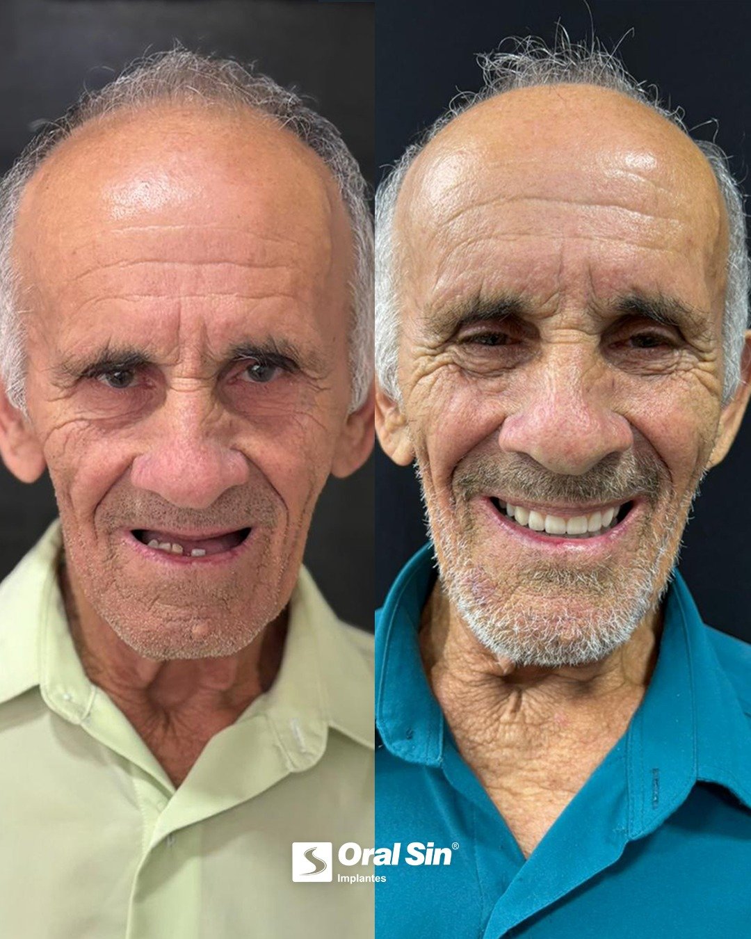 Antes e depois — paciente Oral Sin Sarandi