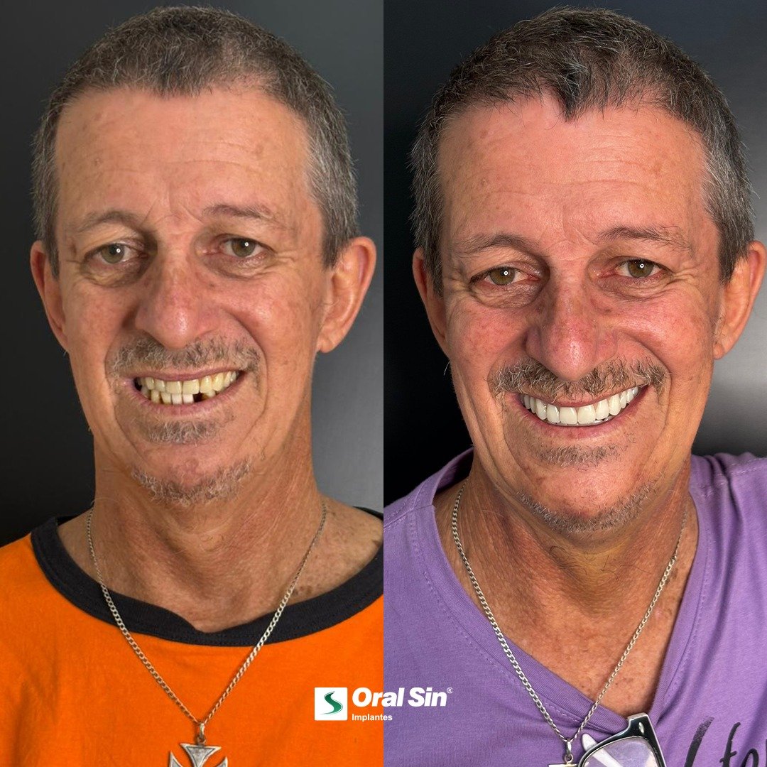 Antes e depois — paciente Oral Sin Sarandi