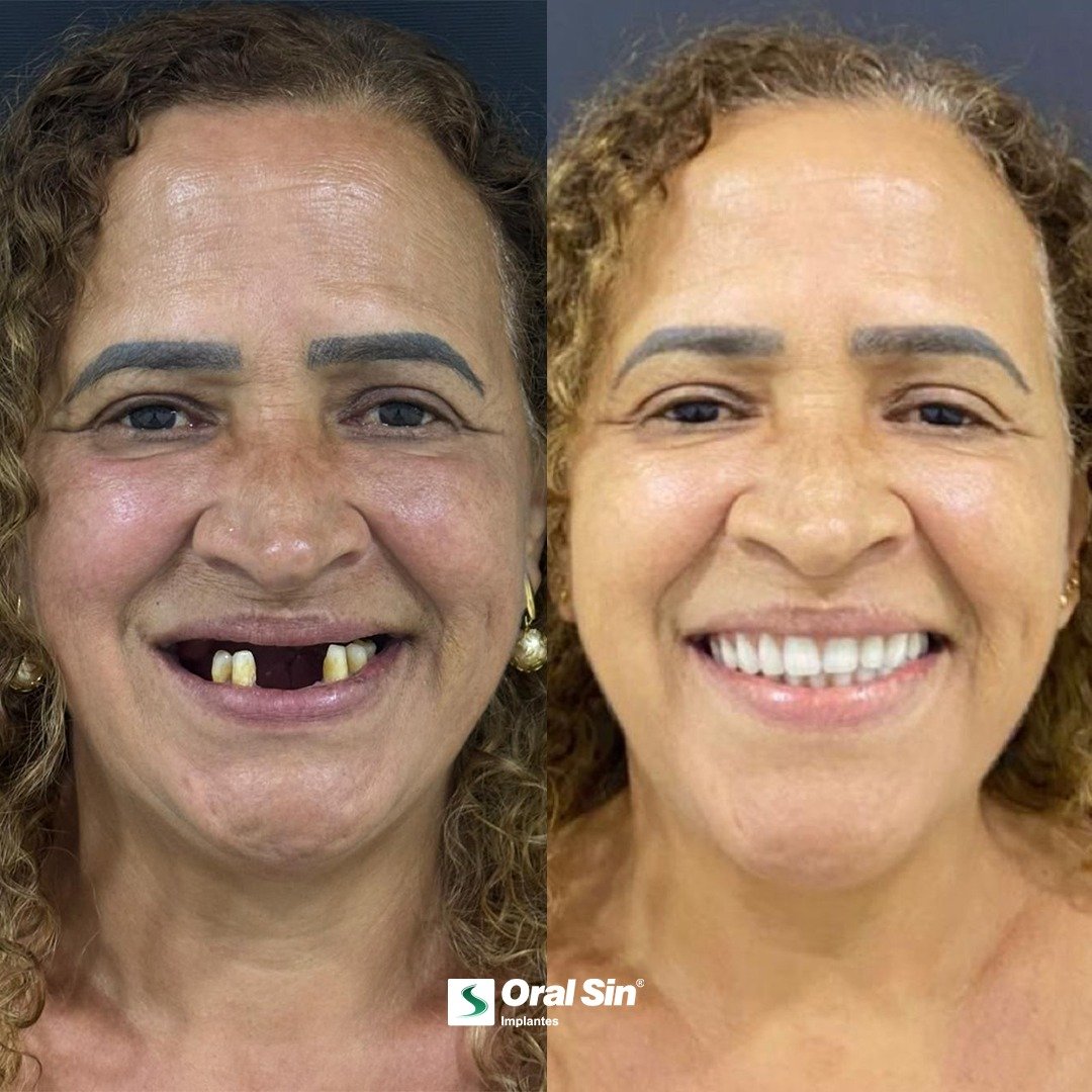 Antes e depois — paciente Oral Sin Sarandi