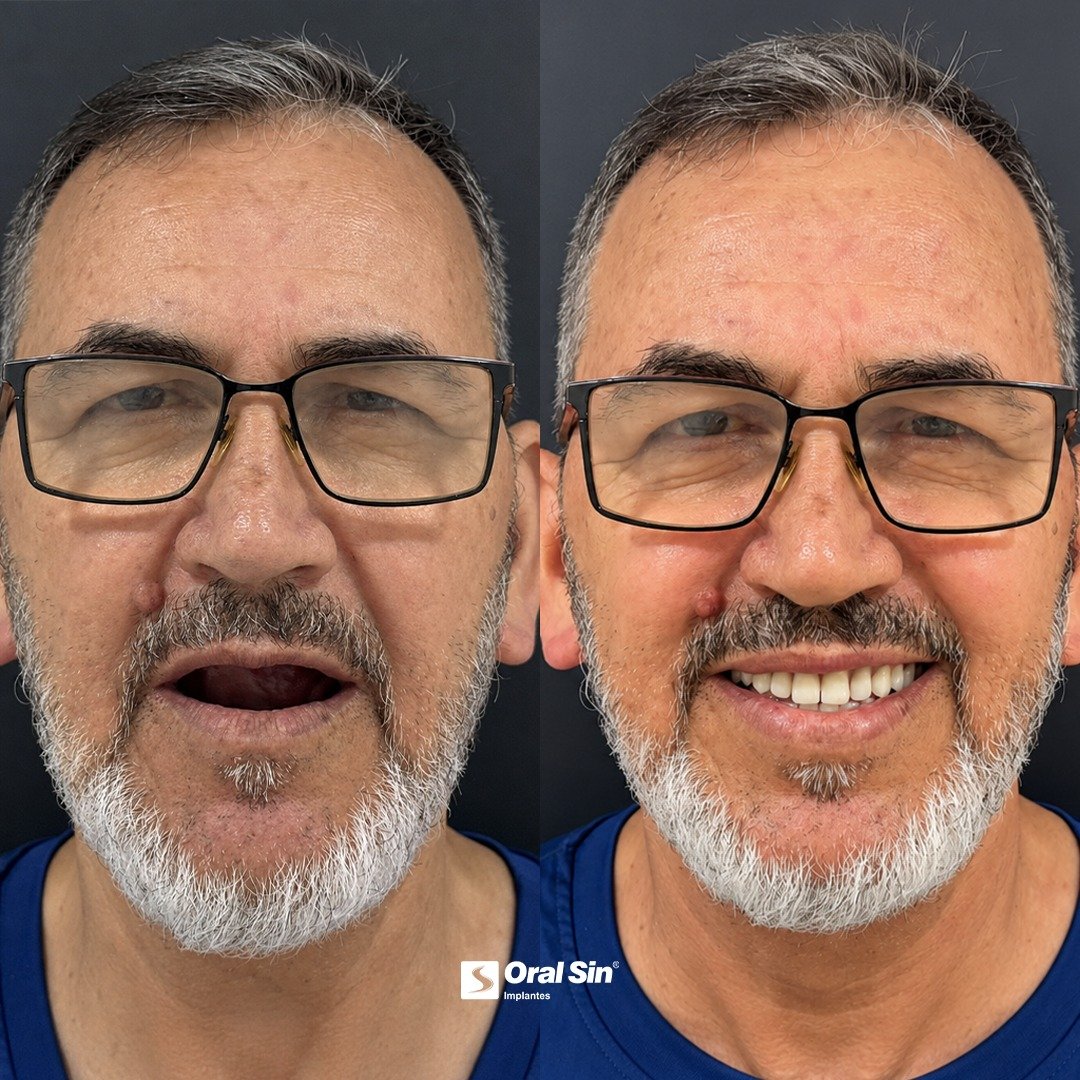 Antes e depois — paciente Oral Sin Sarandi
