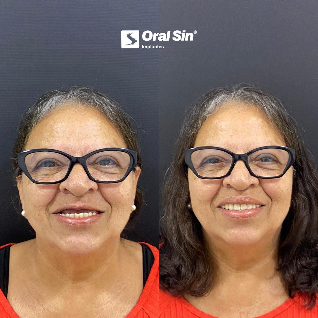 Antes e depois — paciente Oral Sin Sarandi