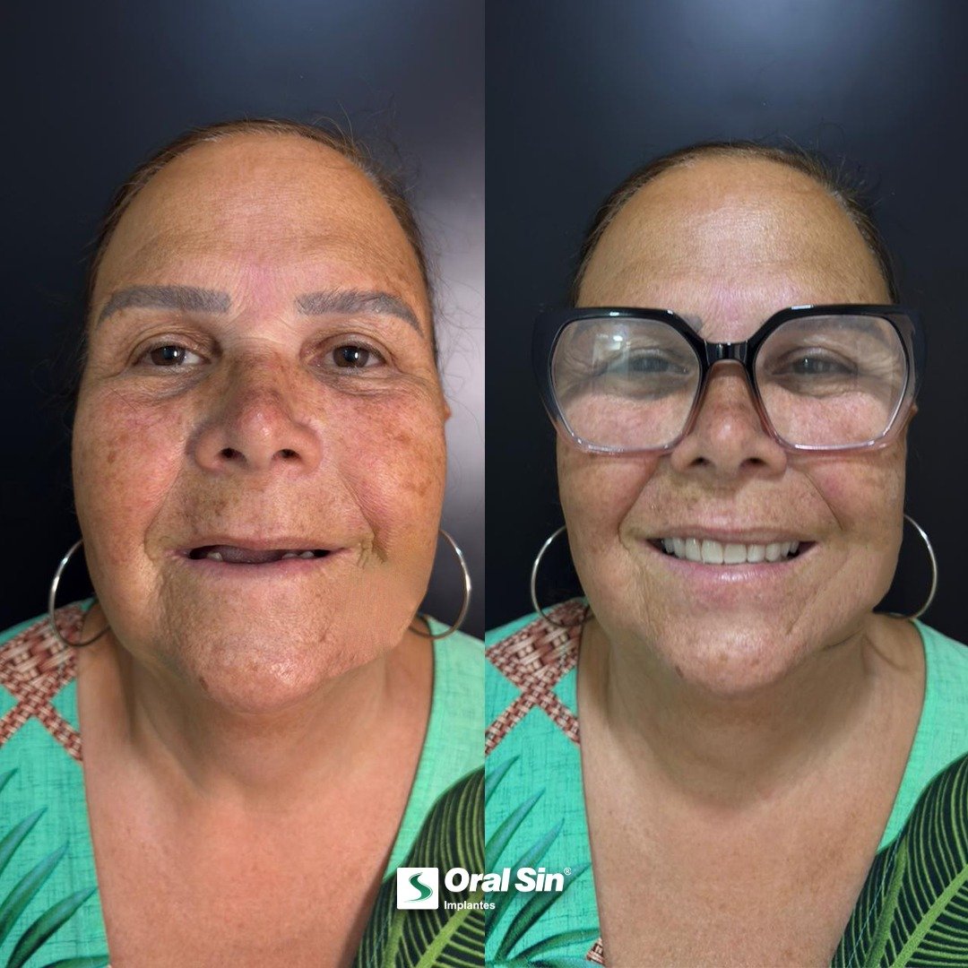 Antes e depois — paciente Oral Sin Sarandi